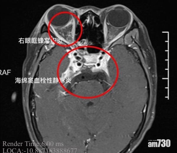 寧波女唧鼻樑暗瘡 顱內嚴重感染險死